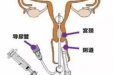 输卵管造影宣传