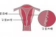 中医治疗薄型子宫内膜