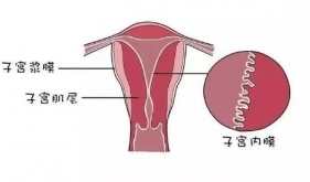 中医治疗薄型子宫内膜